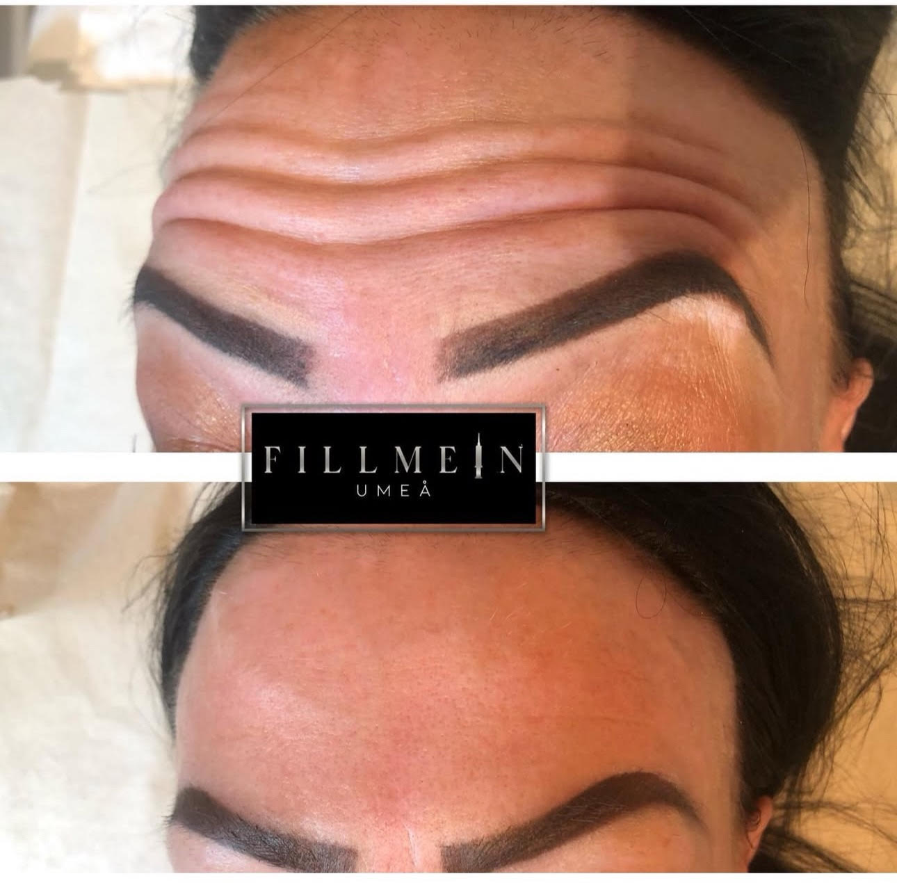 Botox behandling före och efter - synlig minskning av pannrynkor