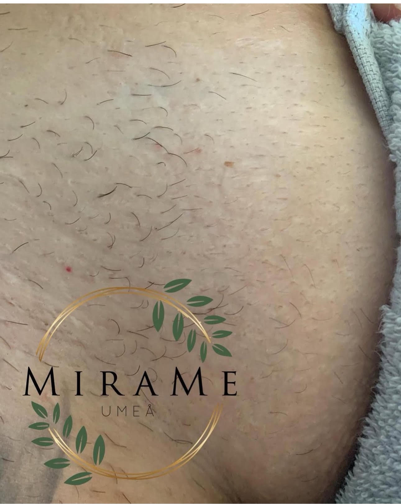 DIOD laser hårborttagning behandling - professionell permanent hårborttagning