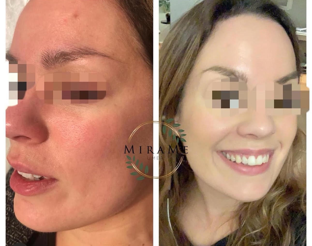 Microneedling med Dermapen 4 före och efter - dramatisk förbättring av hudstruktur och lyster