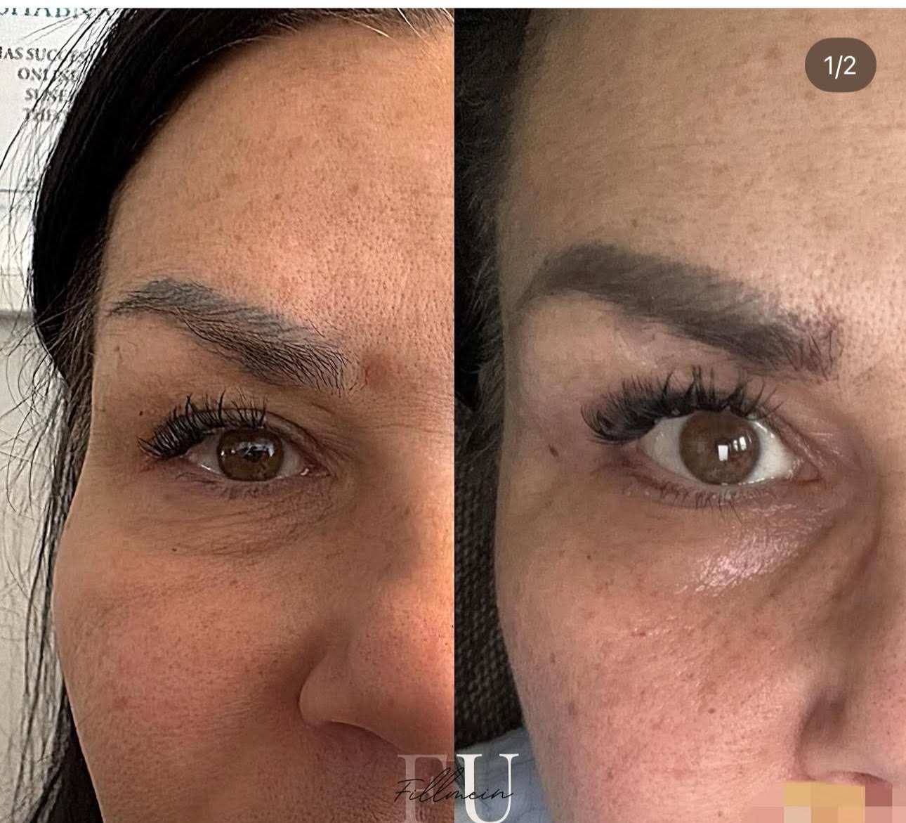 Plasma Pen behandling före och efter - synlig förbättring av kråksparkar och hudtextur