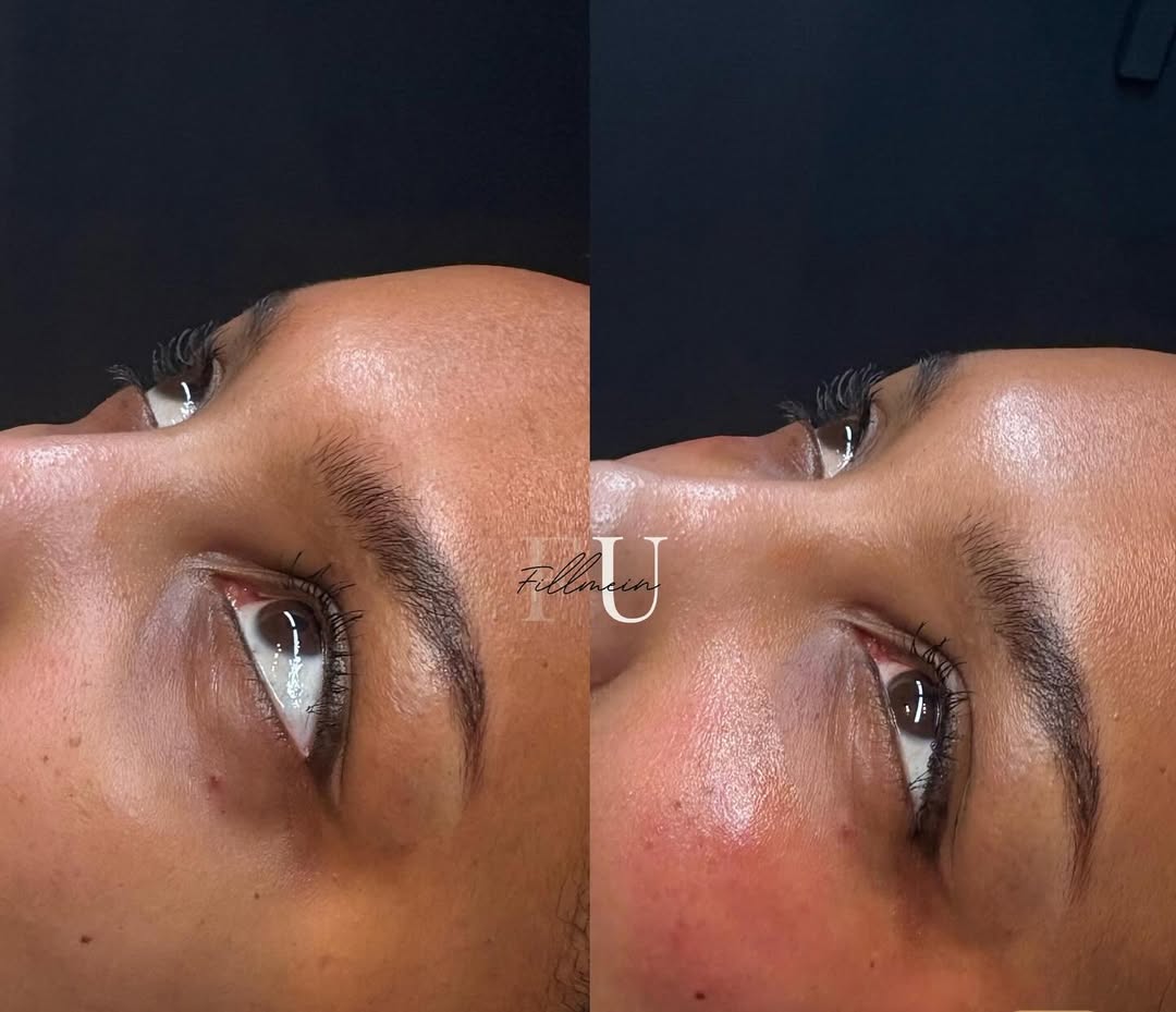 Eyebrow treatment before and after results