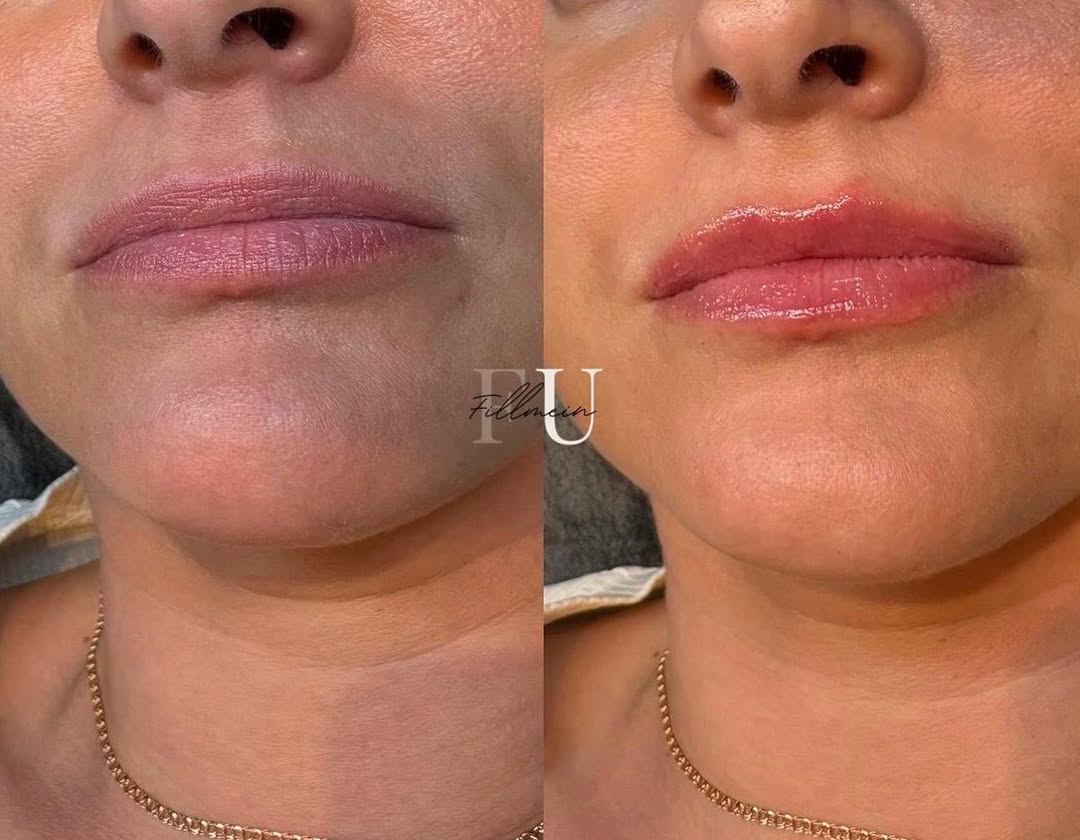 Lip filler treatment before and after