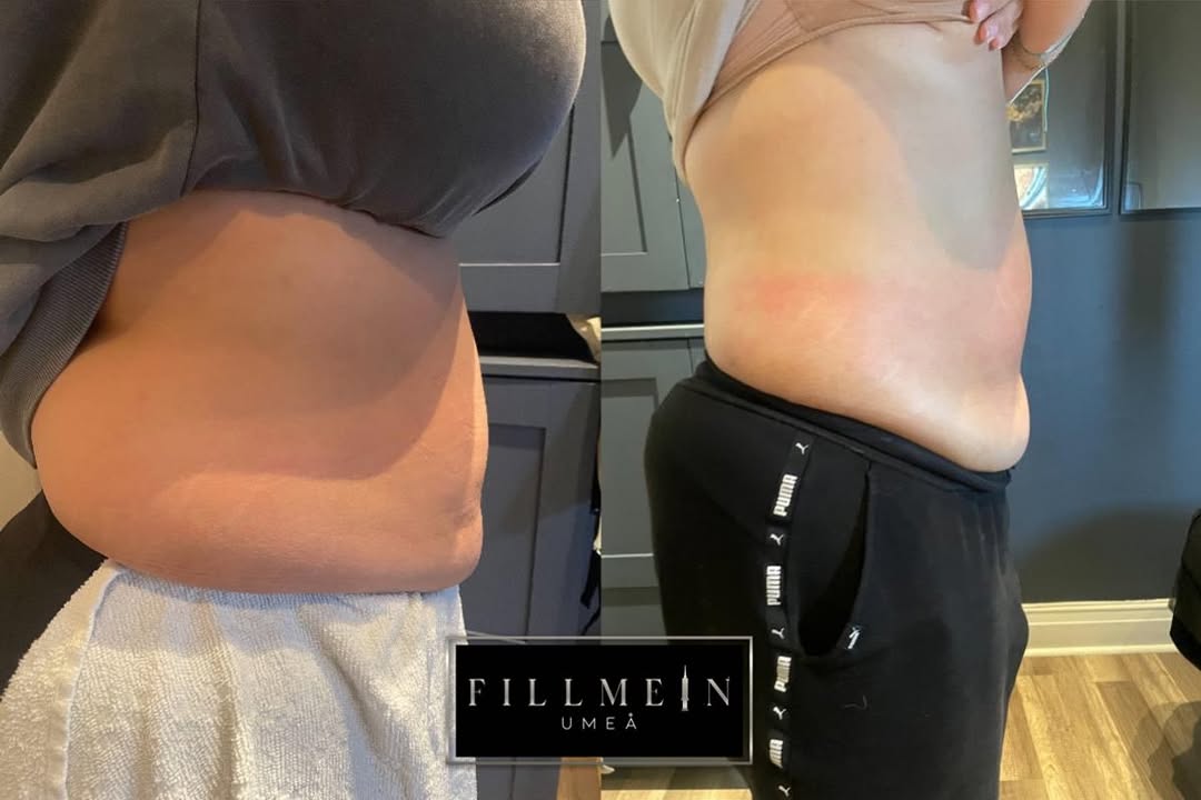 Body contouring treatment results