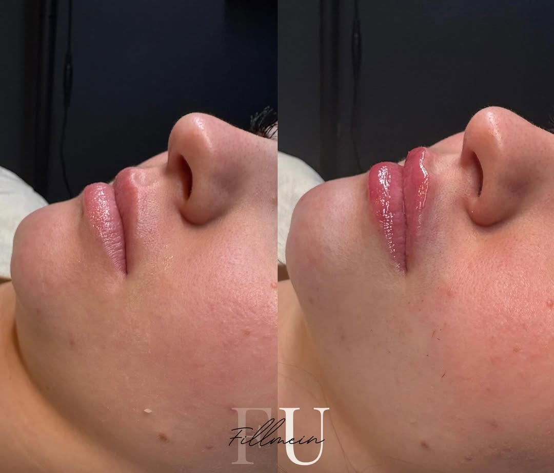 Lip enhancement treatment results