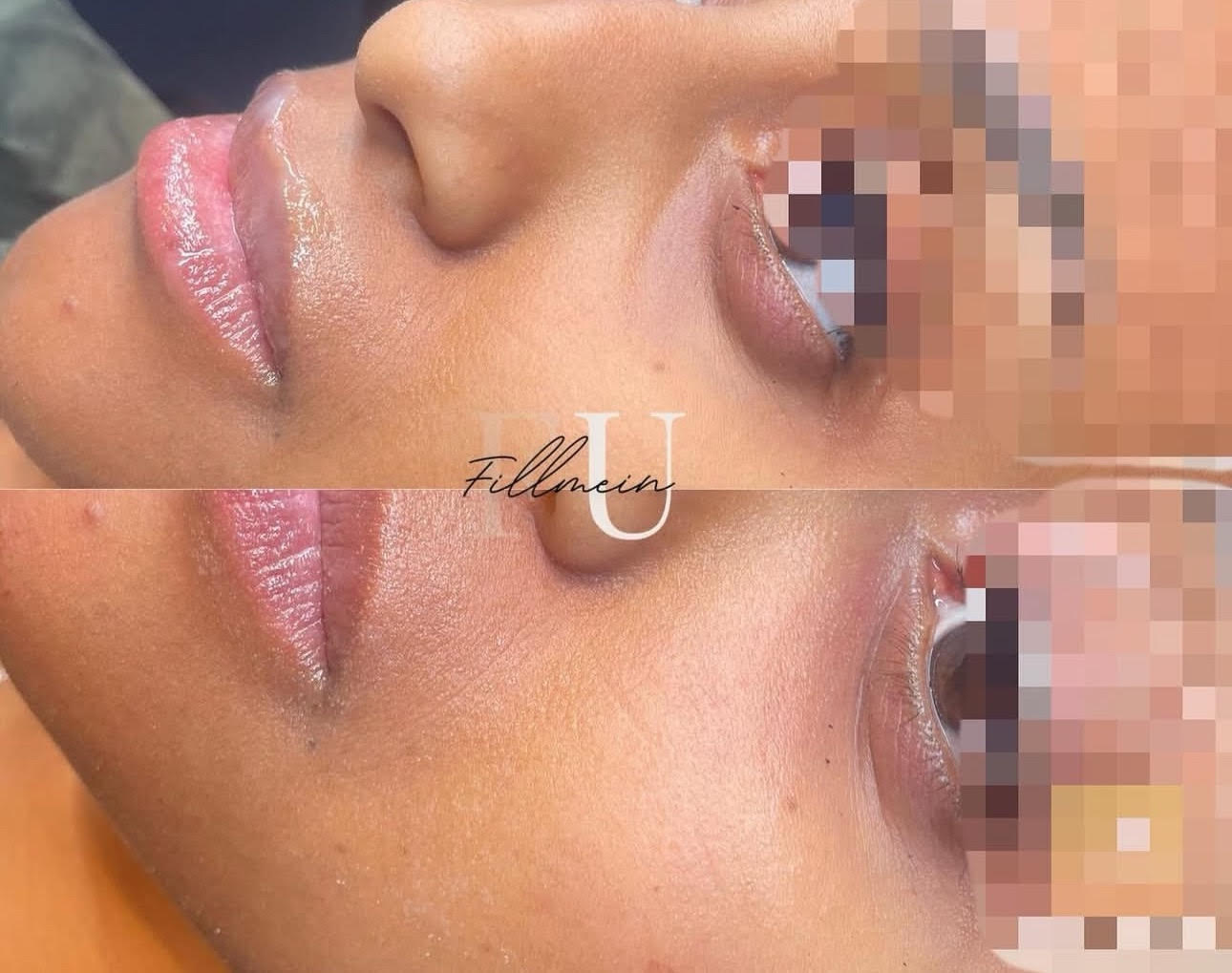 Regenerativ medicin behandling - naturlig hudförnyelse med egna tillväxtfaktorer