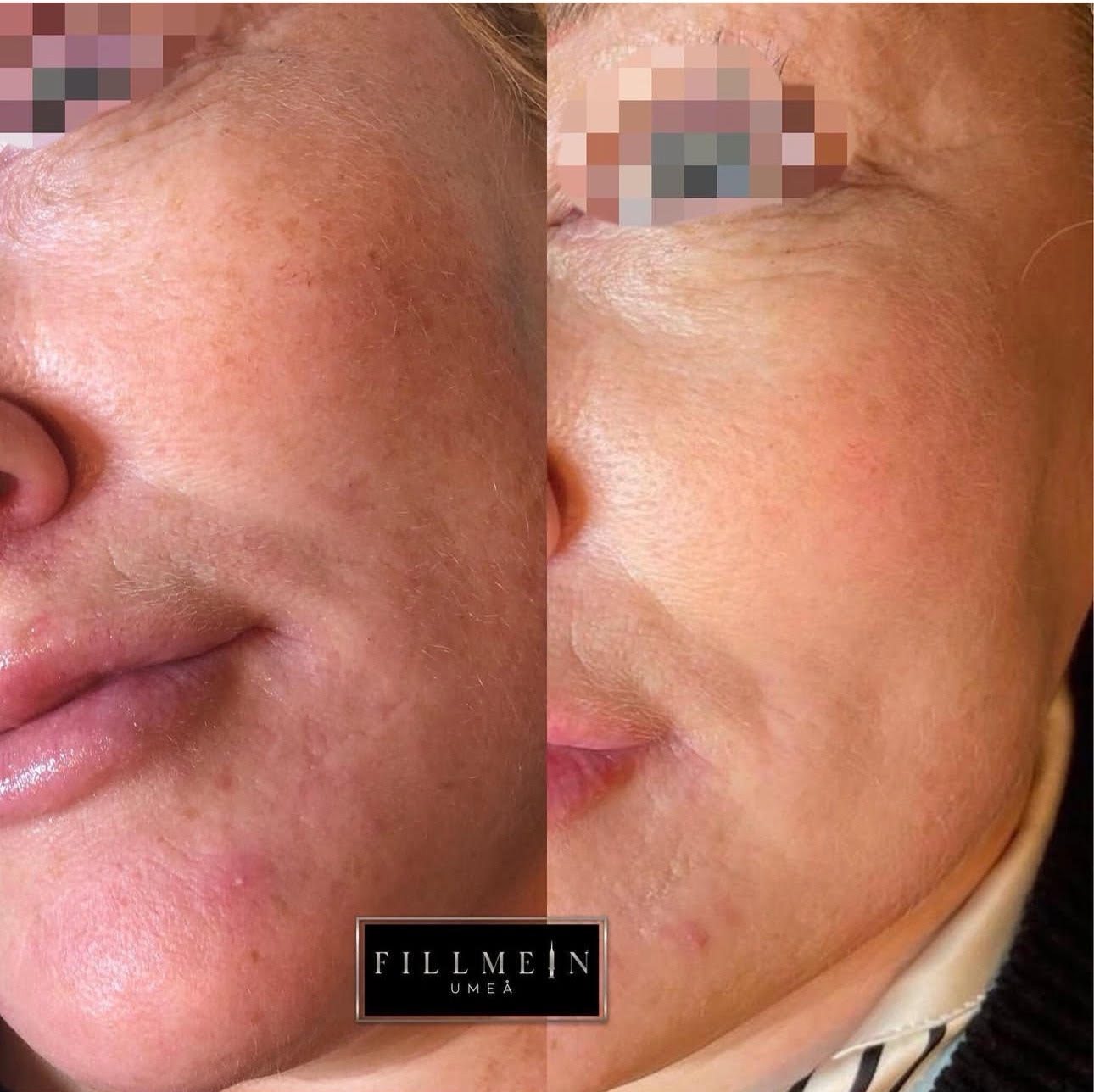 Skinbooster behandling före och efter - dramatisk förbättring av hudkvalitet och lyster